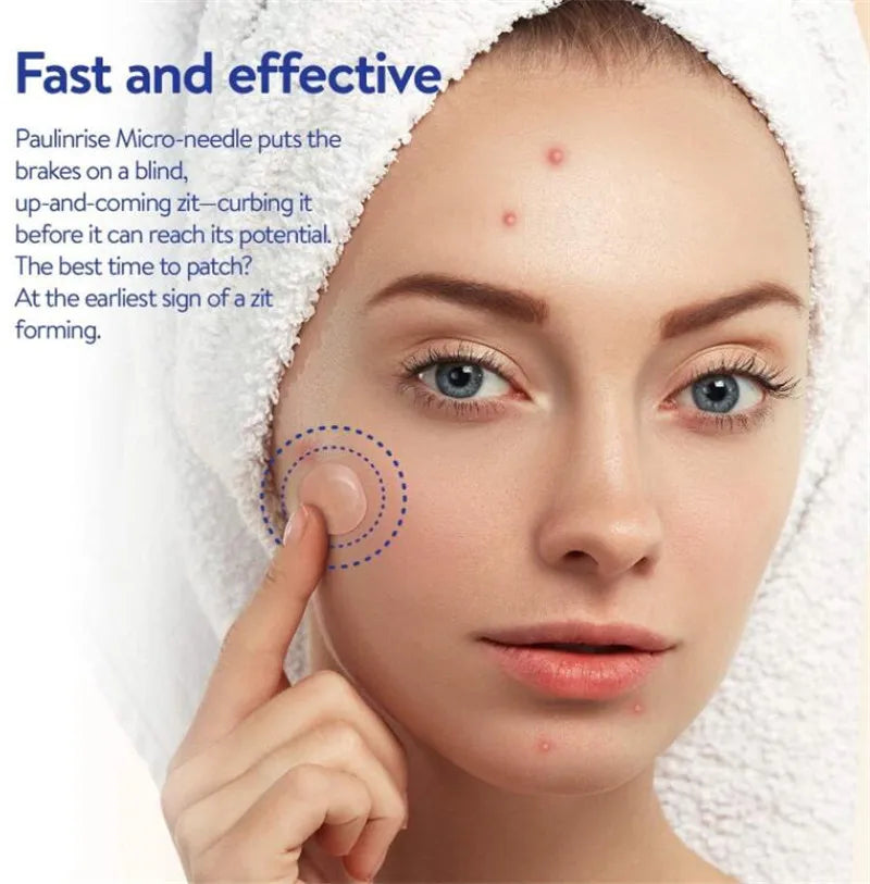 Microneedle Acne Pimple Patches - 9-Pack Fast Healing Zit Stickers with Hyaluronic Acid & Tea Tree Oil