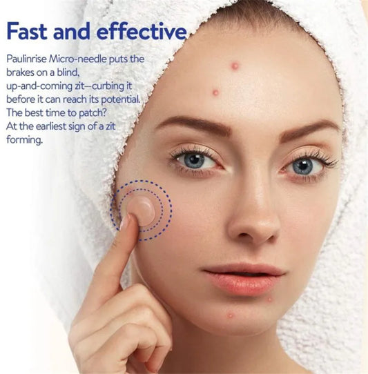 Microneedle Acne Pimple Patches - 9-Pack Fast Healing Zit Stickers with Hyaluronic Acid & Tea Tree Oil