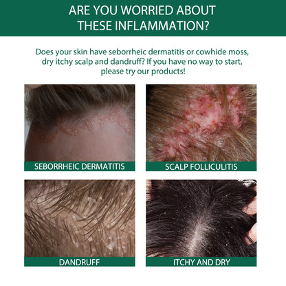 Scalp Treatment Serum - Ginger & Castor Oil Deep Cleansing Essence for Dandruff Repair & Hair Smoothing