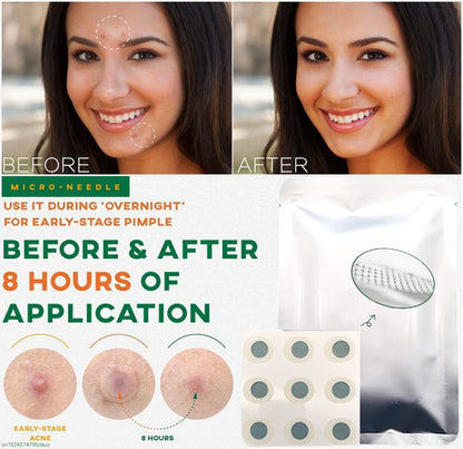 Microneedle Acne Pimple Patches - 9-Pack Fast Healing Zit Stickers with Hyaluronic Acid & Tea Tree Oil
