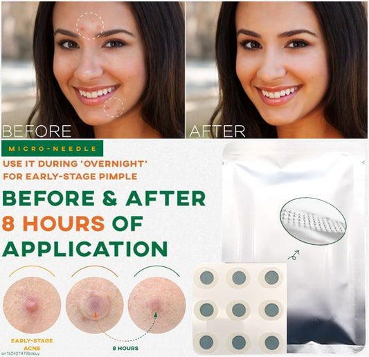 Microneedle Acne Pimple Patches - 9-Pack Fast Healing Zit Stickers with Hyaluronic Acid & Tea Tree Oil
