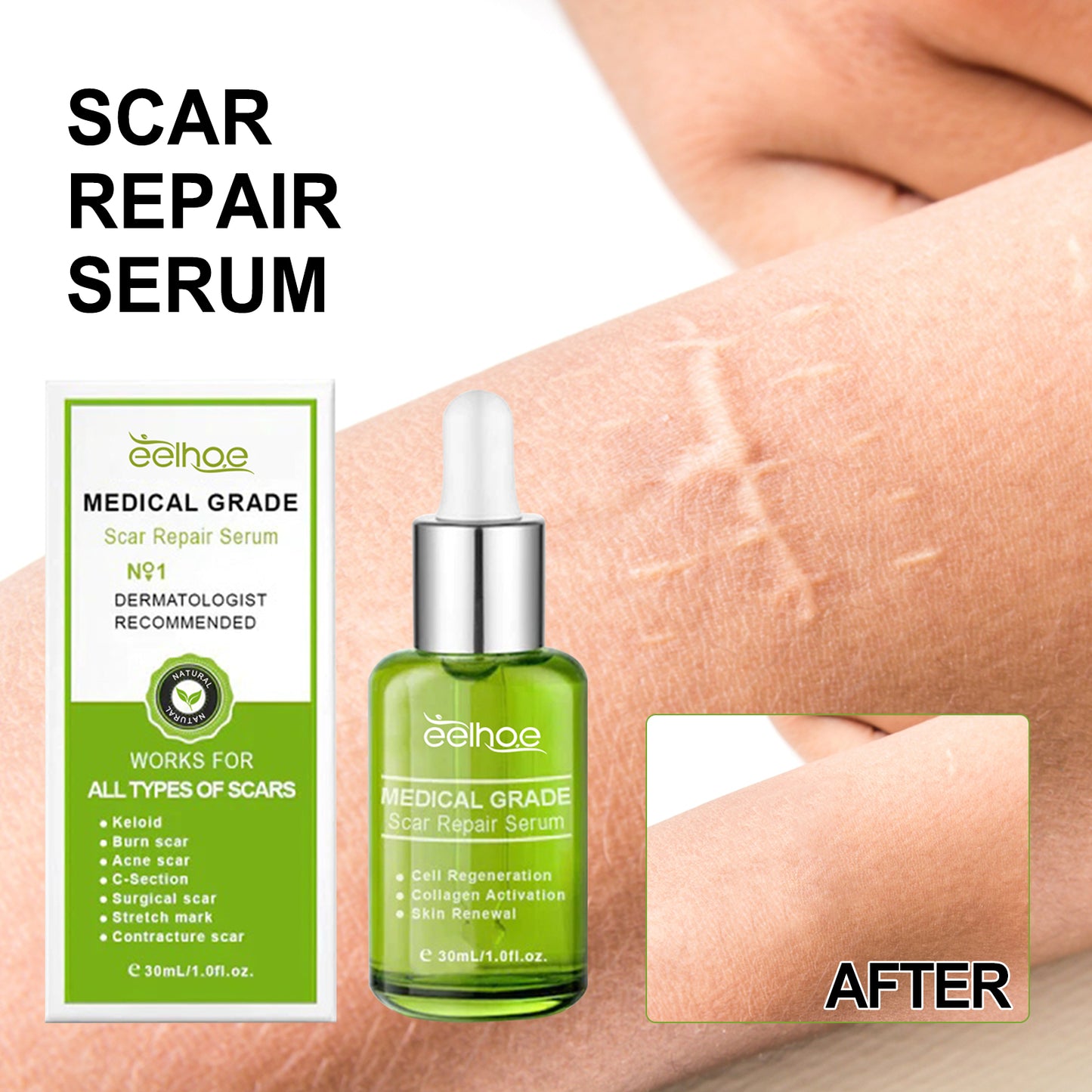 Zarusky Scar Repair Serum - Reduces Acne Marks, Pregnancy & Surgery Scars