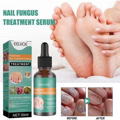 EELHOE Herbaceous Nail Relief Essence – Hand & Foot Care Solution for Softening, Thick Nail Care, Brightening & Bumpy Nails
