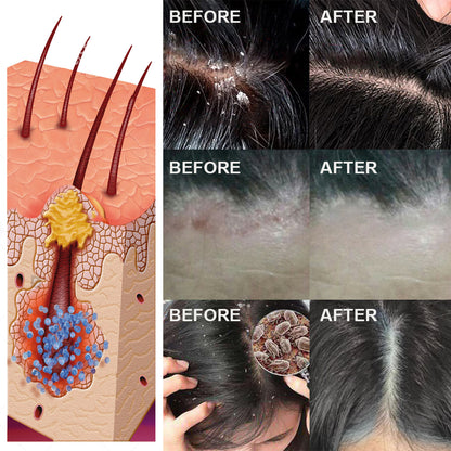 Scalp Treatment Serum - Ginger & Castor Oil Deep Cleansing Essence for Dandruff Repair & Hair Smoothing