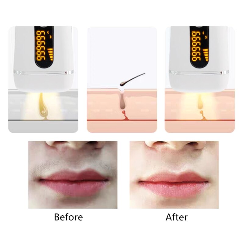 IPL Laser Hair Removal Device - Portable Painless At-Home Treatment