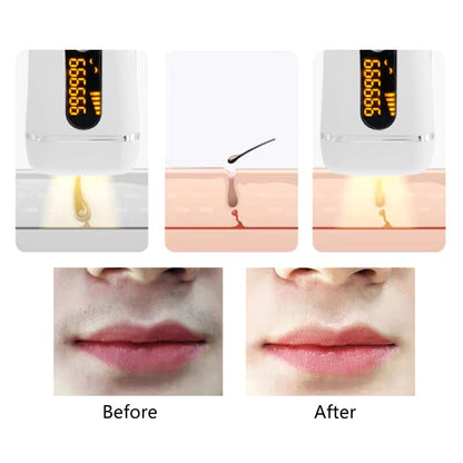 IPL Laser Hair Removal Device - Portable Painless At-Home Treatment